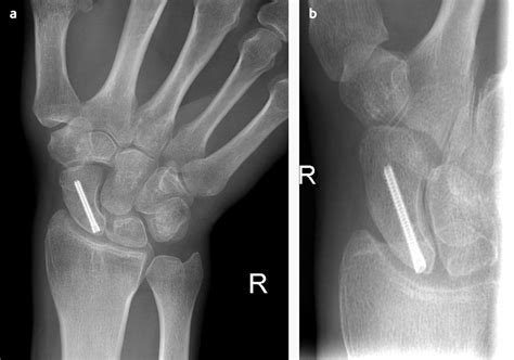 scaphoid fracture compression test|right scaphoid waist fracture.